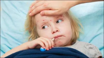 Measles- India TV Hindi