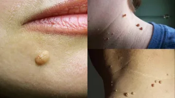 Skin tag remedy - India TV Hindi