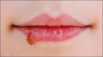 Dry Lips- India TV Hindi
