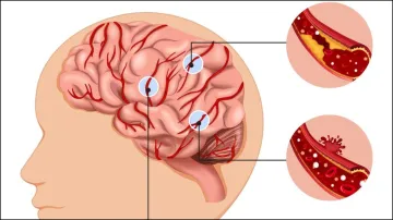 Mini Stroke Symptoms- India TV Hindi