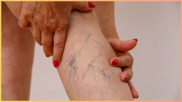 varicose veins- India TV Hindi