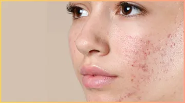  oily acne skin- India TV Hindi