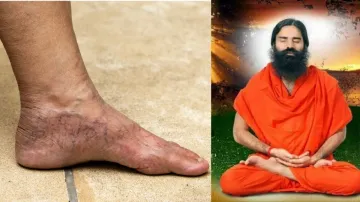  varicose veins tips for Baba Ramdev- India TV Hindi