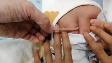 पूंछ के साथ पैदा हुआ बच्चा।- India TV Hindi