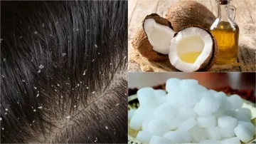 Coconut Oil For Dandruff- India TV Hindi