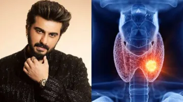 Arjun Kapoor is suffering from Hashimoto- India TV Hindi