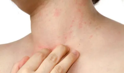 prickly heat rashes- India TV Hindi