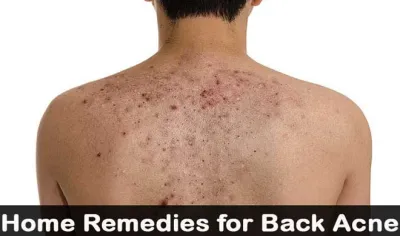 back acne- India TV Hindi