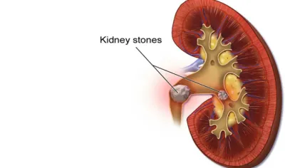 KIDNEY STONE- India TV Hindi