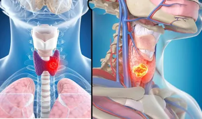  throat cancer- India TV Hindi