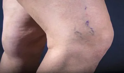 Varcoise vein- India TV Hindi