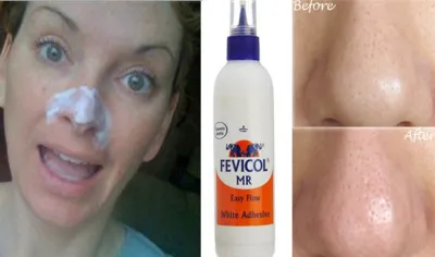 glue fevicol to remove blackheads- India TV Hindi