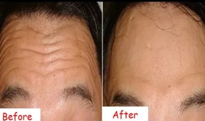 How to Get Rid of Forehead Wrinkles