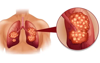 <p><strong><em>Lung Cancer</em></strong></p>- India TV Hindi