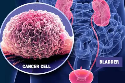 <p>bladder cancer</p>- India TV Hindi