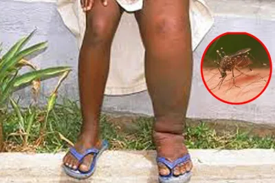 lymphatic filariasis- India TV Hindi