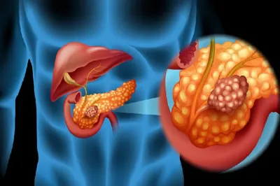 pancreatic cancer - India TV Hindi