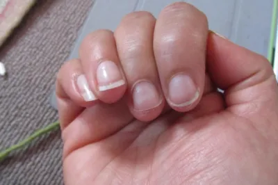 <p>Nail Abnormalities</p>- India TV Hindi