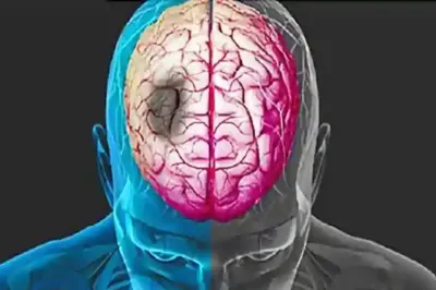 <p>brain stroke</p>- India TV Hindi