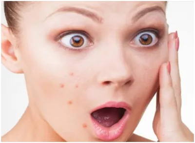 Pimple free skin- India TV Hindi