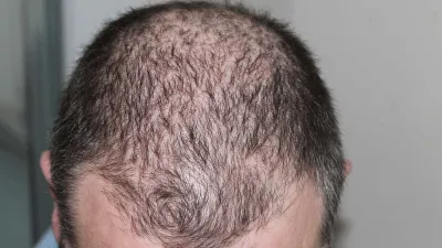 Hair Loss Complaints, Covid Patients Hair Loss, Covid Patients Hair Loss Complaints- India TV Hindi