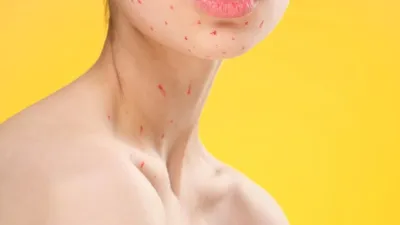 Chickenpox Stains- India TV Hindi