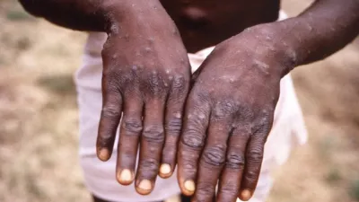 Monkeypox Cases- India TV Hindi