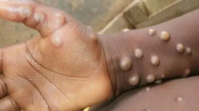 Monkeypox- India TV Hindi