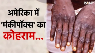 Monkeypox- India TV Hindi