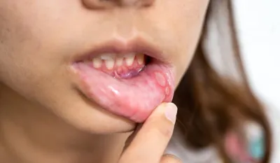 Mouth Ulcers- India TV Hindi