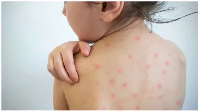 measles- India TV Hindi