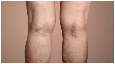 Varicose_veins - India TV Hindi