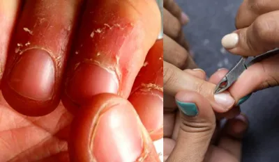 Cuticle peeling pain- India TV Hindi