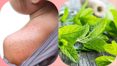 home remedies for heat rash- India TV Hindi