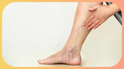 Varicose_veins- India TV Hindi