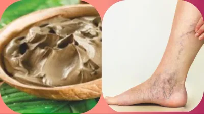 Varicose veins home remedies- India TV Hindi