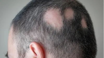  Alopecia areata - India TV Hindi