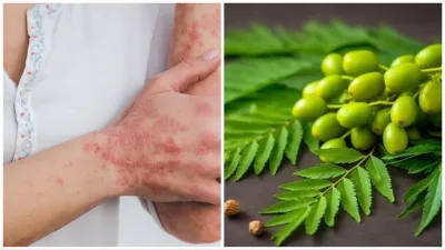 best medicine for skin diseases- India TV Hindi