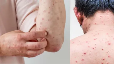 Chickenpox Clade 9 causes- India TV Hindi