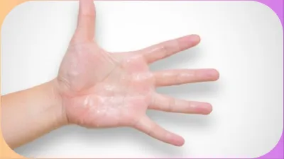  excessive sweating of the hands - India TV Hindi