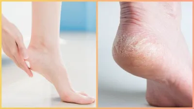 remedies to heal cracked heels - India TV Hindi