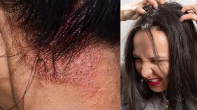 Scalp Infection Treatment At Home- India TV Hindi