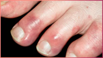 chilblains causes- India TV Hindi