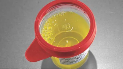 Yellow urine reason- India TV Hindi