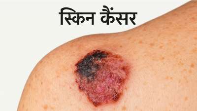 स्किन कैंसर त्वचा की कोशिकाओं में होने वाला सबसे आम कैंसर है। यह धूप में ज़्यादा रहने या आनुवंशिक कारणों से हो सकता है। शुरुआत में इसके लक्षण सामान्य त्वचा की समस्याओं जैसे दिख सकते हैं, लेकिन अगर इन्हें नज़रअंदाज़ किया जाए, तो यह गंभीर हो सकता है। किसी भी कैंसर की तरह, अगर इसका पता जल्दी चल जाए, तो इलाज ज़्यादा असरदार होता है और ठीक होने की संभावना भी बढ़ जाती है। आइए त्वचा कैंसर के कुछ शुरुआती लक्षण जो मामूली त्वचा परिवर्तनों से कहीं ज़्यादा हैं।
स्किन कैंसर त्वचा की कोशिकाओं में होने वाला सबसे आम कैंसर है। यह धूप में ज़्यादा रहने या आनुवंशिक कारणों से हो सकता है। शुरुआत में इसके लक्षण सामान्य त्वचा की समस्याओं जैसे दिख सकते हैं, लेकिन अगर इन्हें नज़रअंदाज़ किया जाए, तो यह गंभीर हो सकता है। किसी भी कैंसर की तरह, अगर इसका पता जल्दी चल जाए, तो इलाज ज़्यादा असरदार होता है और ठीक होने की संभावना भी बढ़ जाती है। आइए त्वचा कैंसर के कुछ शुरुआती लक्षण जो मामूली त्वचा परिवर्तनों से कहीं ज़्यादा हैं।