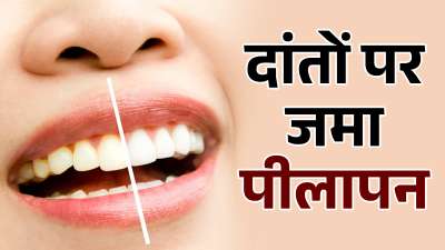 अगर आपने अपने दांतों की सही तरीके से देखभाल नहीं की, तो आपके दांतों में कीड़े लग सकते हैं। अगर आप डेंटिस्ट के पास नहीं जाना चाहते, तो अपनी ओरल हेल्थ पर भी ध्यान दीजिए। एक जरूरी विटामिन की कमी आपके दांतों के लिए नुकसानदायक साबित हो सकती है। अगर आपने अपने दांतों की सही तरीके से देखभाल नहीं की, तो आपके दांतों में कीड़े लग सकते हैं। अगर आप डेंटिस्ट के पास नहीं जाना चाहते, तो अपनी ओरल हेल्थ पर भी ध्यान दीजिए। एक जरूरी विटामिन की कमी आपके दांतों के लिए नुकसानदायक साबित हो सकती है।