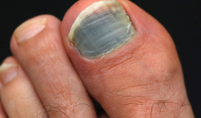 Know What Reason To Black Toenail India Tv Hindi News