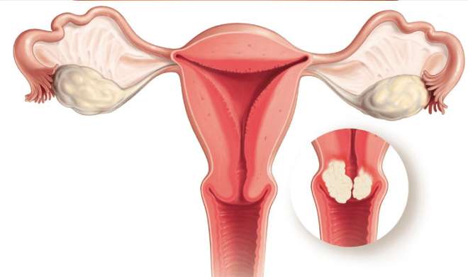 Cervical Cancer Symptoms Signs Causes Stages And Treatment 16 स 30 स ल तक क मह ल ओ म सर व इकल क सर क ह सबस ज य द खतर र सर च India Tv Hindi News