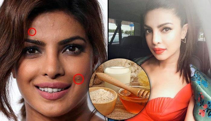 priyanka chopra acne