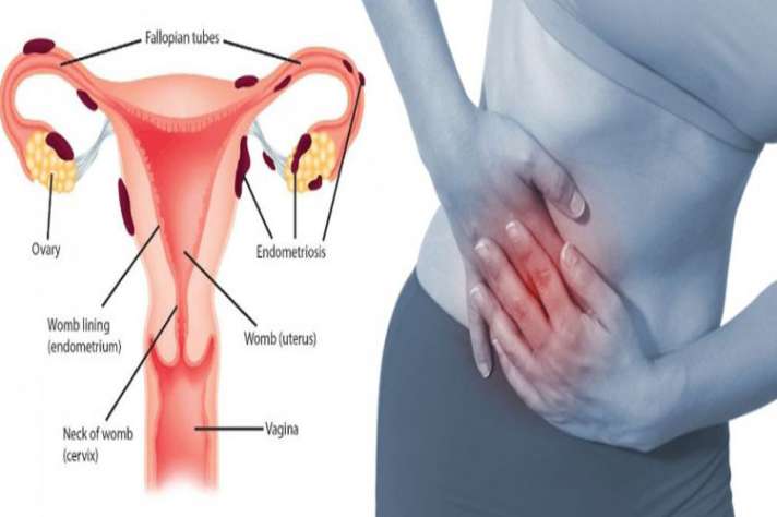 Understanding Endometriosis In Hindi Symptoms Causes Stage And Treatment आख र मह ल ओ क सबस ज य द क य ह त ह ए ड म ट र य स स ब म र ज न लक षण क रण और इल ज India Tv